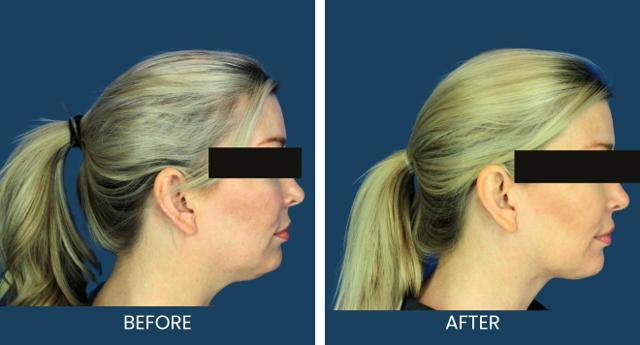 Deep Plane Facelift result at Plano Plastic Surgery — MedSpa in Plano, TX