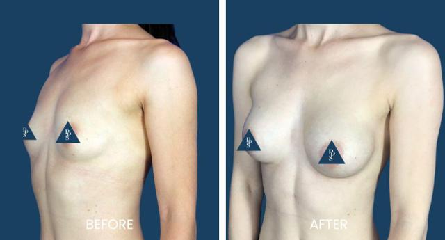 Breast Lift result at Plano Plastic Surgery — MedSpa in Plano, TX