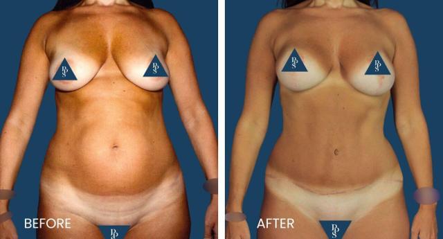 Mommy Makeover result at Plano Plastic Surgery — MedSpa in Plano, TX