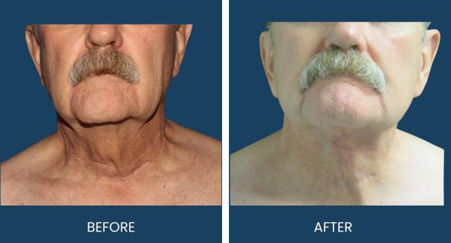 Deep Plane Facelift result at Plano Plastic Surgery — MedSpa in Plano, TX