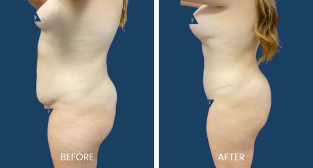 Tummy Tuck result at Plano Plastic Surgery — MedSpa in Plano, TX