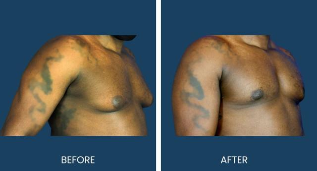 Gynecomastia Surgery result at Plano Plastic Surgery — MedSpa in Plano, TX