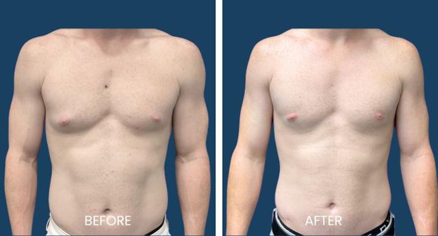 Gynecomastia Surgery result at Plano Plastic Surgery — MedSpa in Plano, TX