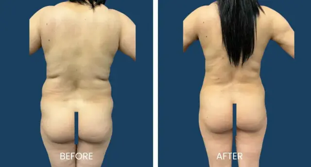 Liposuction result at Plano Plastic Surgery — MedSpa in Plano, TX