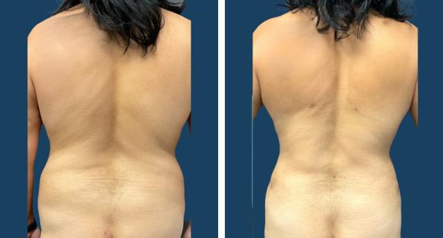 Liposuction result at Plano Plastic Surgery — MedSpa in Plano, TX