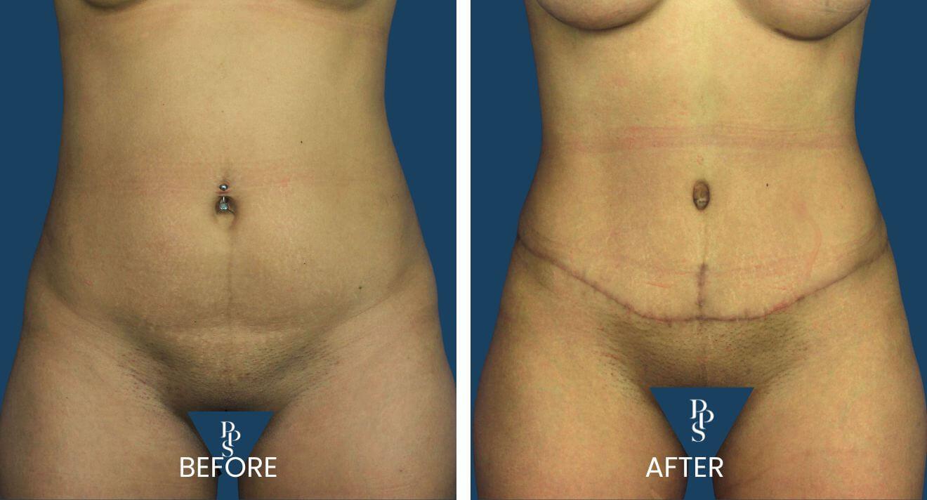 Plano Plastic Surgery — MedSpa result — Plano, TX