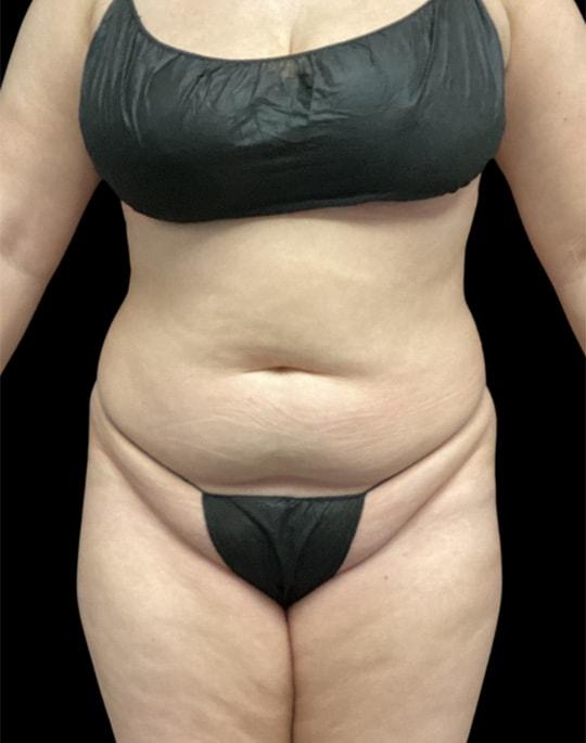 Liposuction before at Adam N. Kinal, MD in Orlando, FL