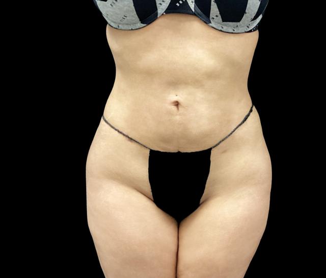 Liposuction after at Adam N. Kinal, MD in Orlando, FL