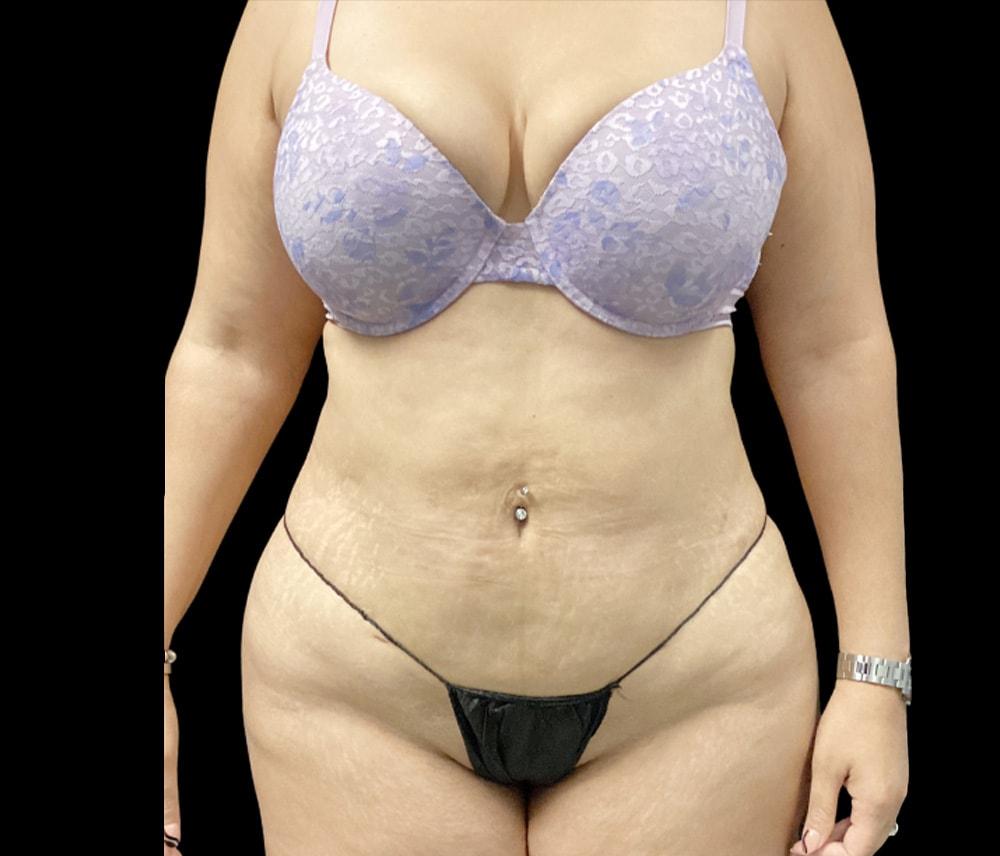 Adam N. Kinal, MD liposuction after — Orlando, FL