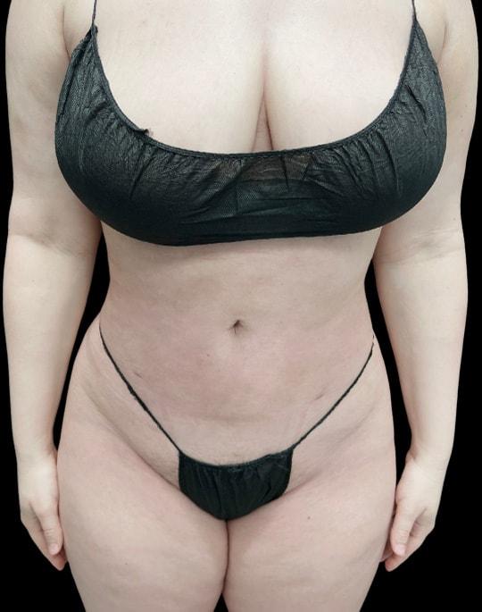 Adam N. Kinal, MD liposuction after — Orlando, FL