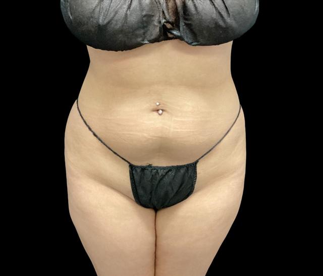 Liposuction before at Adam N. Kinal, MD in Orlando, FL
