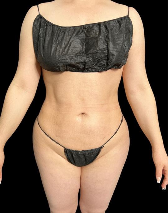Adam N. Kinal, MD liposuction after — Orlando, FL