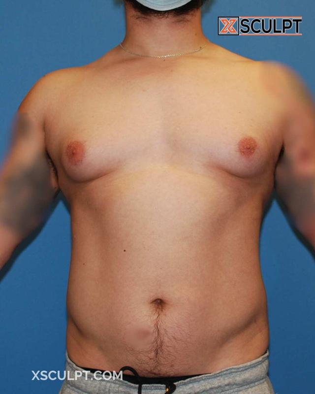 Gynecomastia Surgery before at XSculpt in Chicago, IL