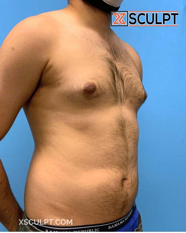 Gynecomastia Surgery before at XSculpt in Chicago, IL