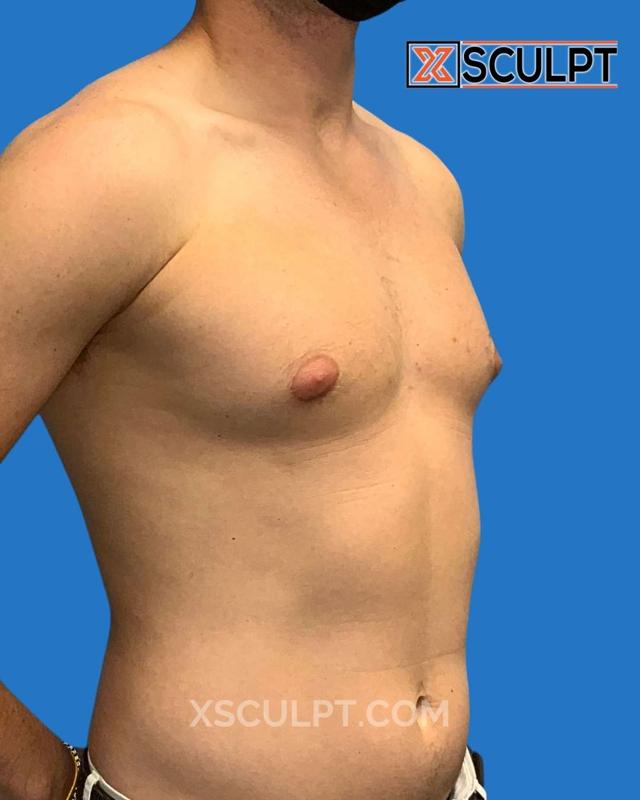 Breast Reduction result at XSculpt in Chicago, IL