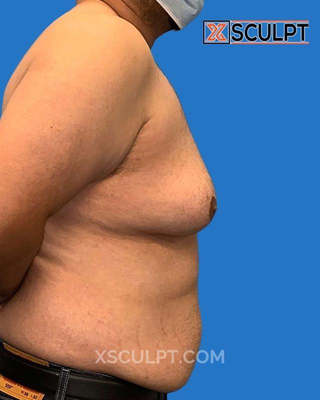 Gynecomastia Surgery before at XSculpt in Chicago, IL
