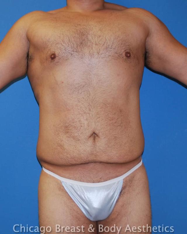 Mini Tummy Tuck before at XSculpt in Chicago, IL