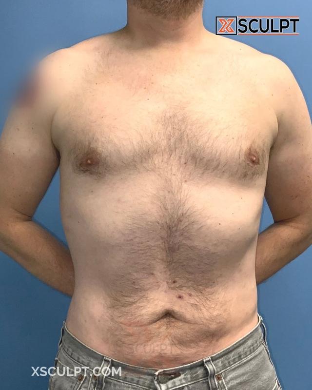 Liposuction after at XSculpt in Chicago, IL