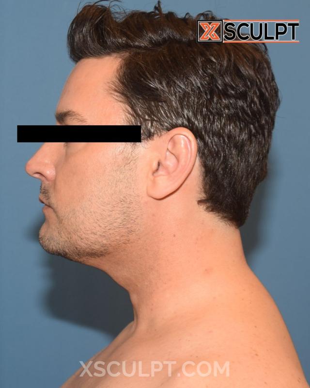 Neck Liposuction after at XSculpt in Chicago, IL