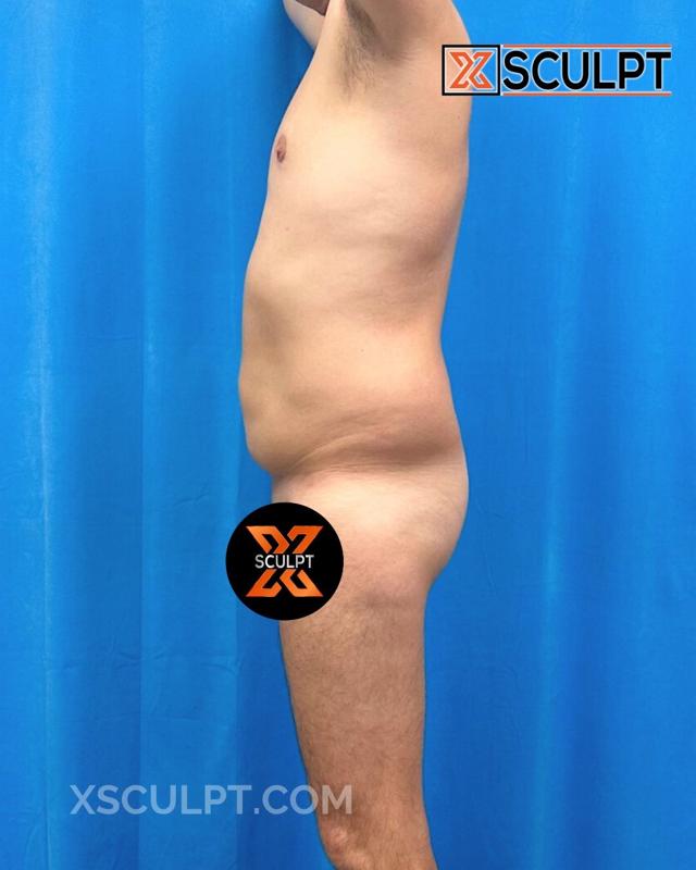 Brazilian Butt Lift before at XSculpt in Chicago, IL