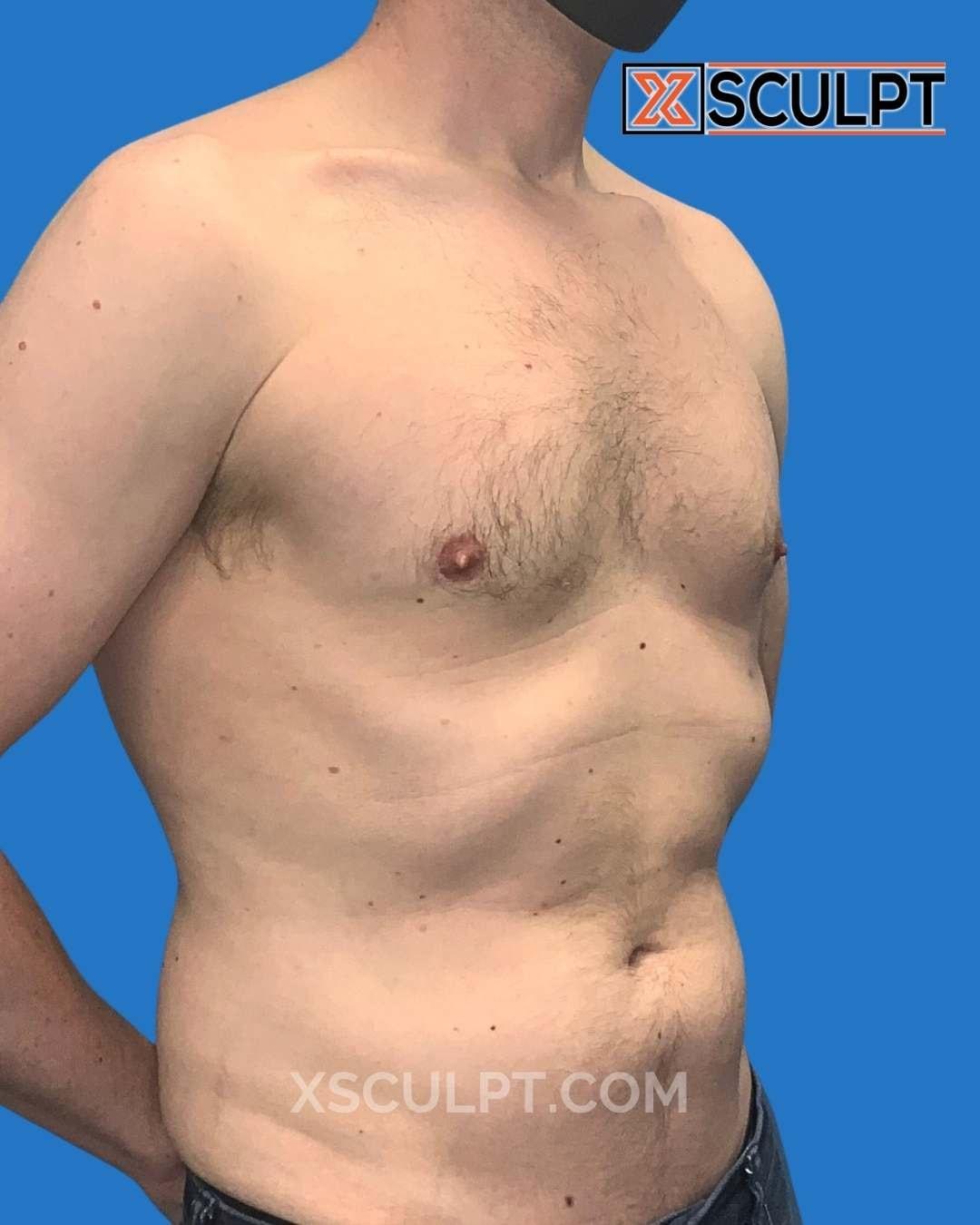 XSculpt gynecomastia after — Chicago, IL
