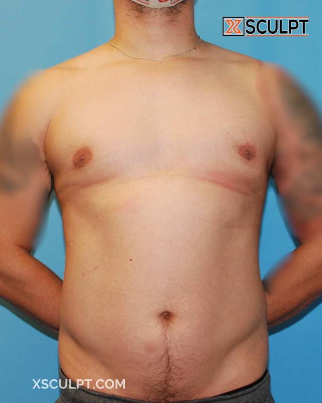 Gynecomastia Surgery after at XSculpt in Chicago, IL