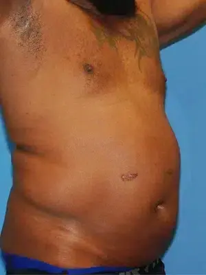Liposuction before at XSculpt in Chicago, IL