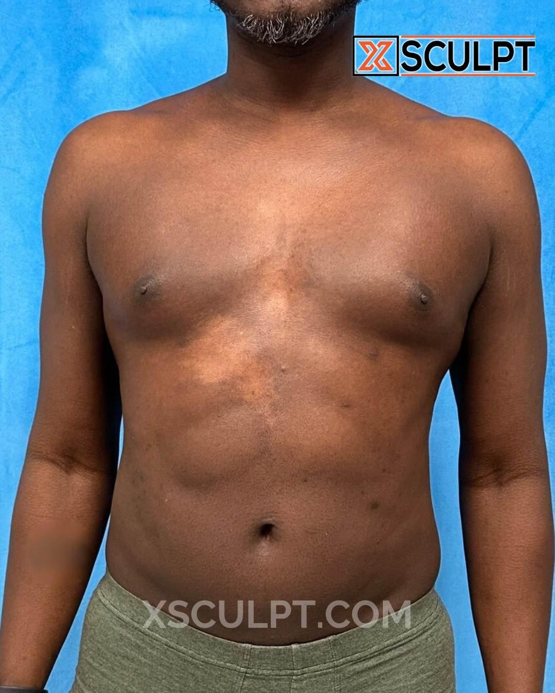 XSculpt liposuction after — Chicago, IL