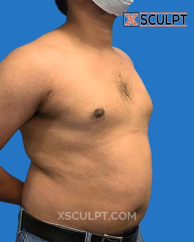 Breast Reduction result at XSculpt in Chicago, IL