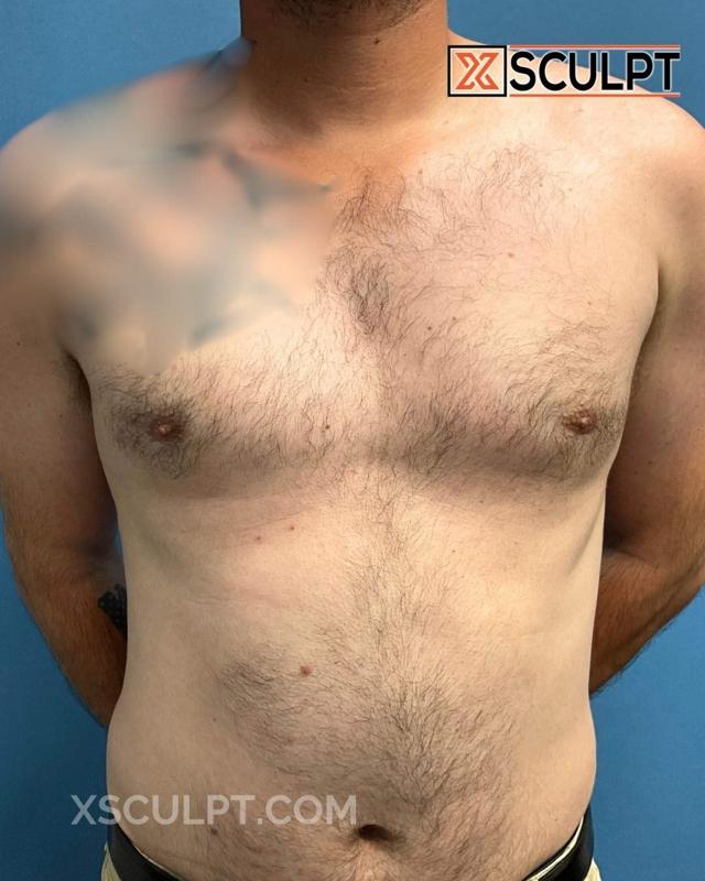 Gynecomastia Surgery after at XSculpt in Chicago, IL