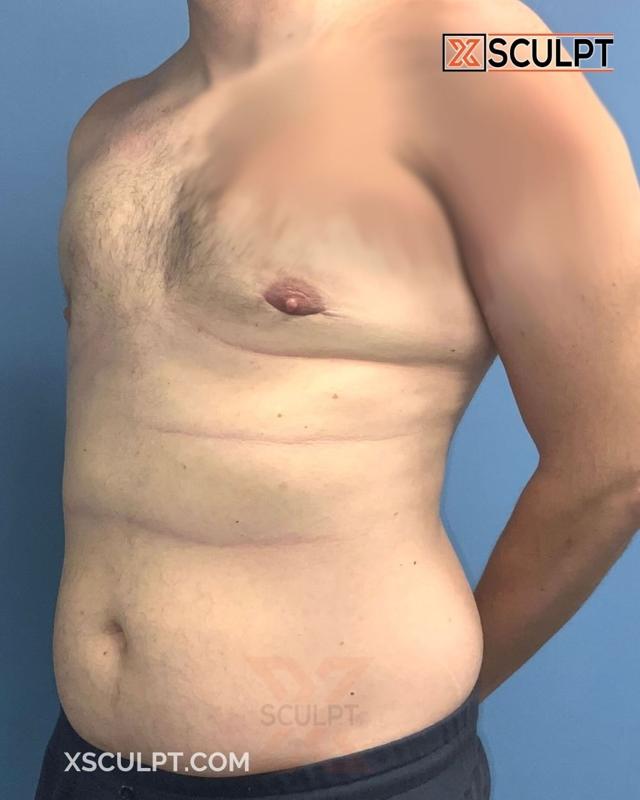Gynecomastia Surgery after at XSculpt in Chicago, IL