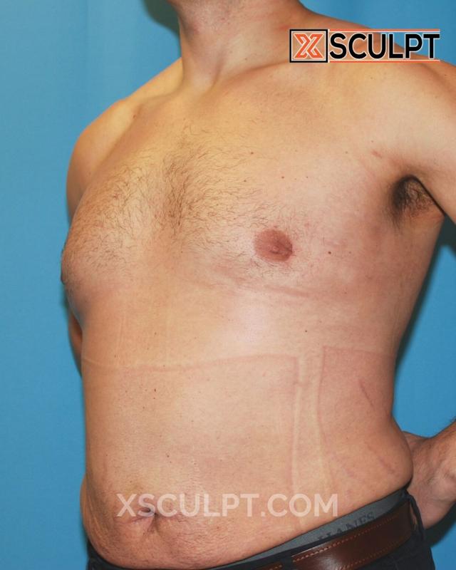 Gynecomastia Surgery after at XSculpt in Chicago, IL