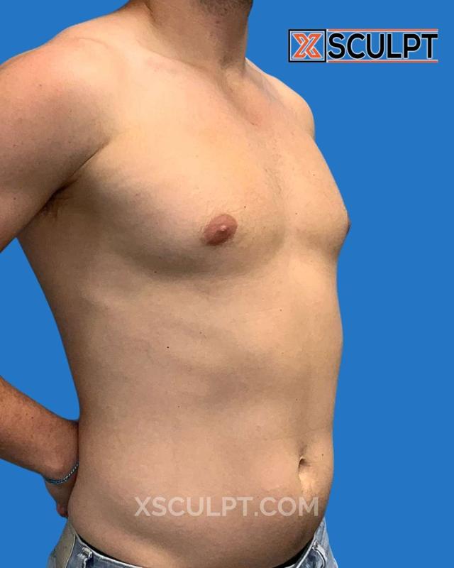 Breast Reduction result at XSculpt in Chicago, IL