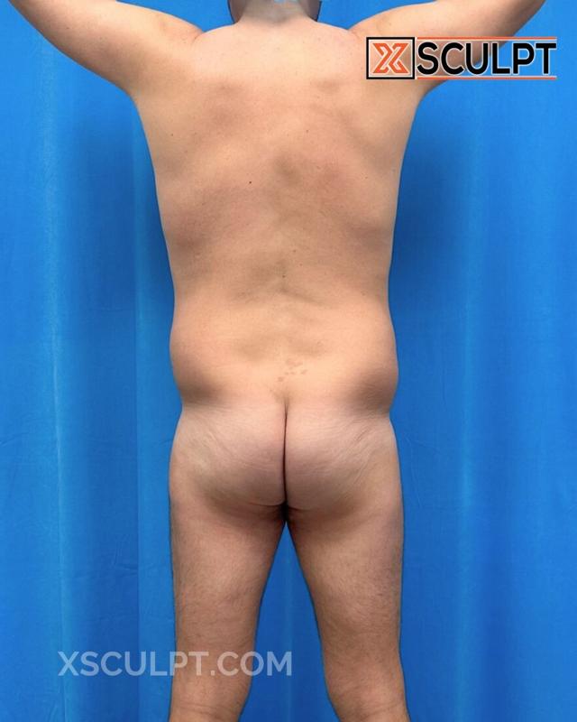Brazilian Butt Lift before at XSculpt in Chicago, IL