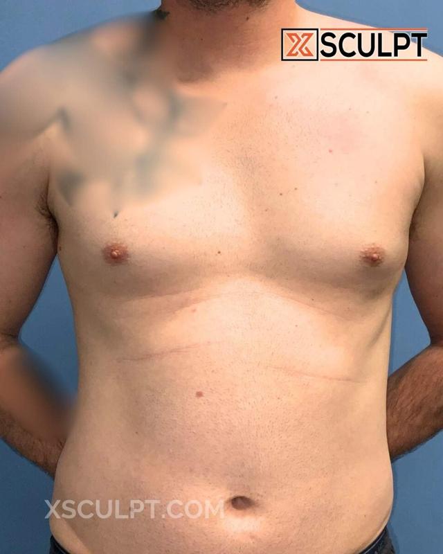 Gynecomastia Surgery before at XSculpt in Chicago, IL