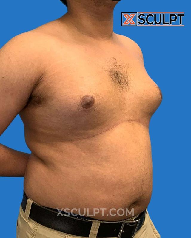 Breast Reduction result at XSculpt in Chicago, IL