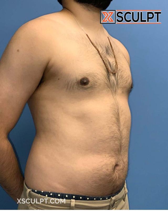 Gynecomastia Surgery after at XSculpt in Chicago, IL