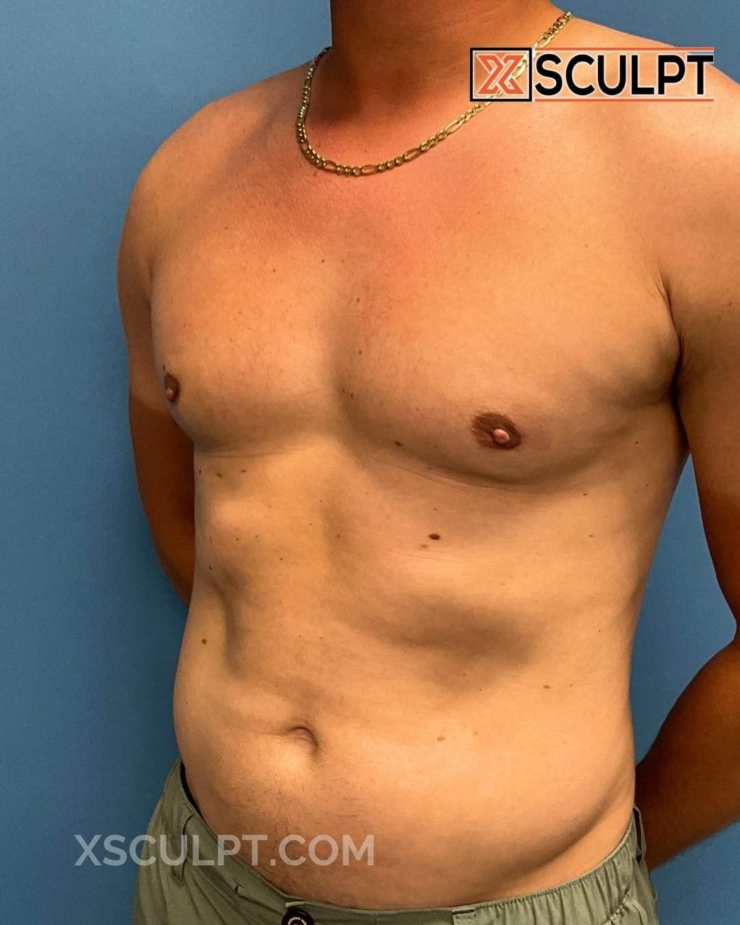 XSculpt gynecomastia after — Chicago, IL