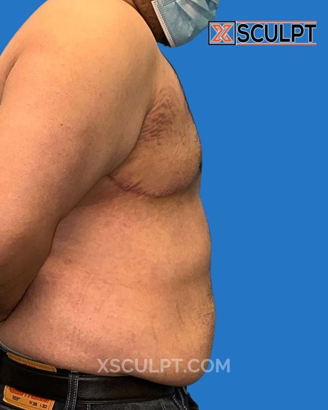 Gynecomastia Surgery after at XSculpt in Chicago, IL
