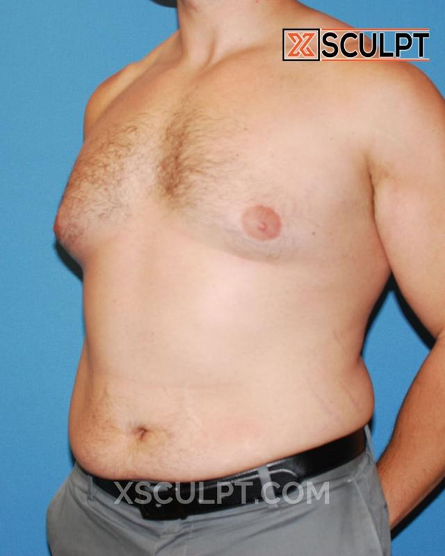 Gynecomastia Surgery before at XSculpt in Chicago, IL