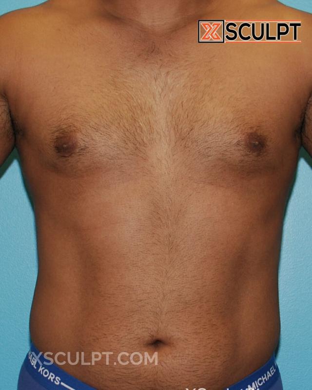 Liposuction before at XSculpt in Chicago, IL