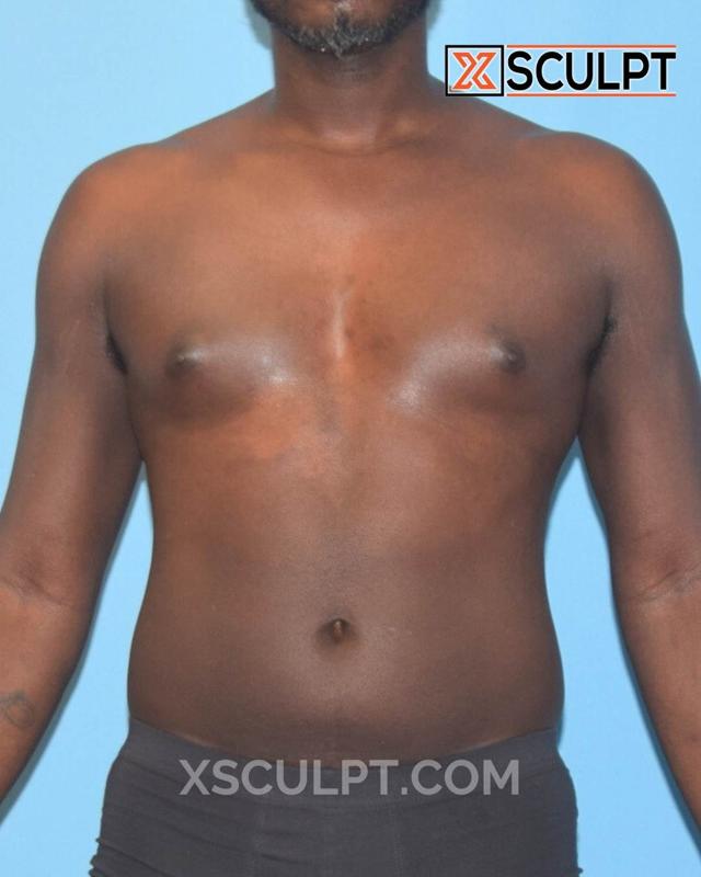 Liposuction before at XSculpt in Chicago, IL