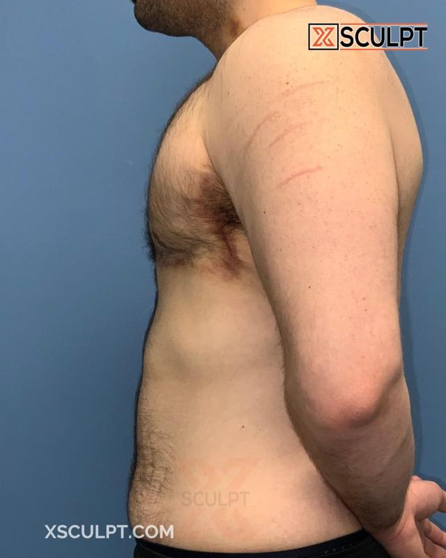 Gynecomastia Surgery after at XSculpt in Chicago, IL