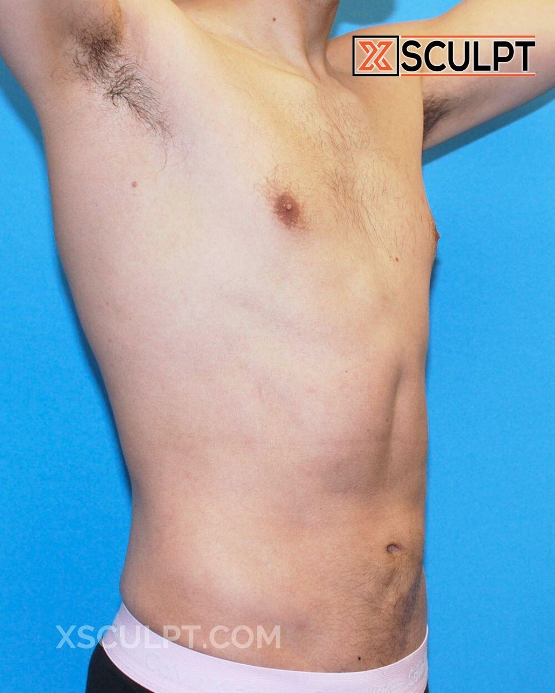 XSculpt liposuction after — Chicago, IL