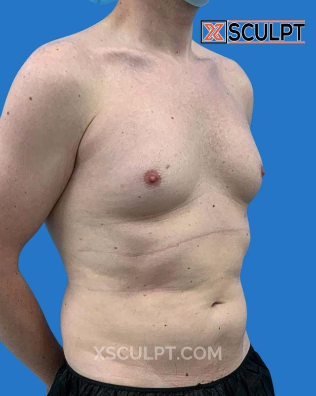Gynecomastia Surgery before at XSculpt in Chicago, IL