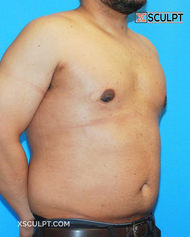 Gynecomastia Surgery after at XSculpt in Chicago, IL