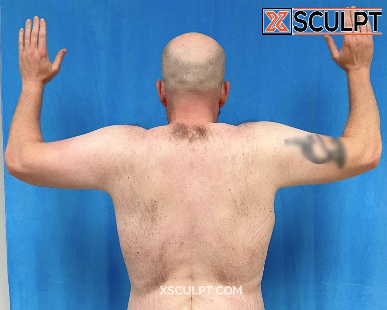 XSculpt arm lift after — Chicago, IL