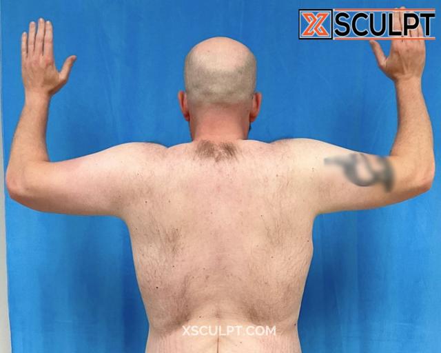 Arm Lift after at XSculpt in Chicago, IL