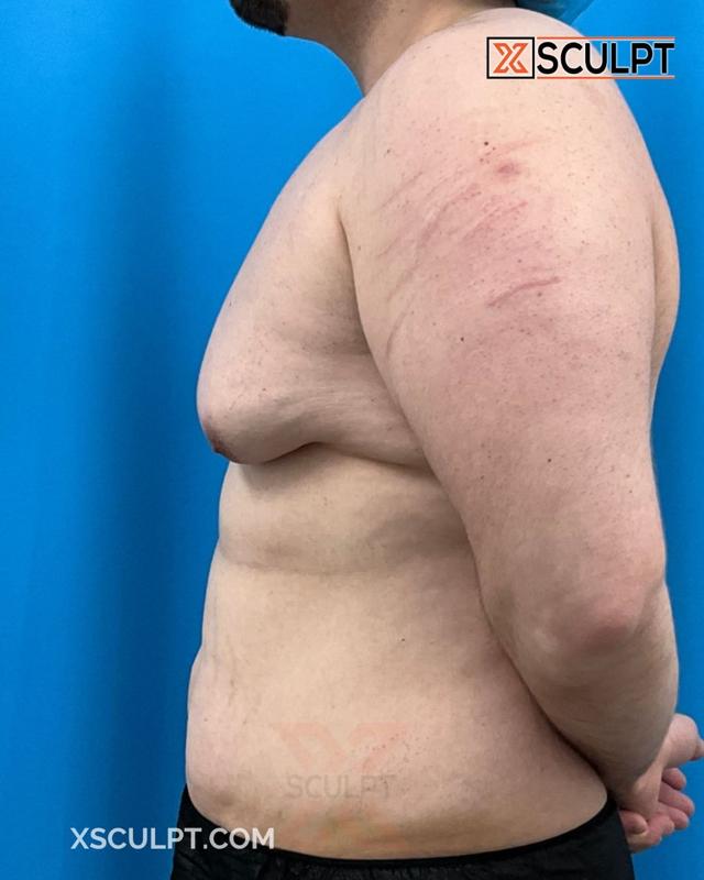 Gynecomastia Surgery before at XSculpt in Chicago, IL