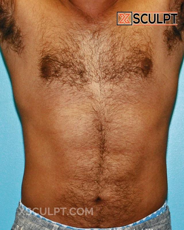 Liposuction after at XSculpt in Chicago, IL